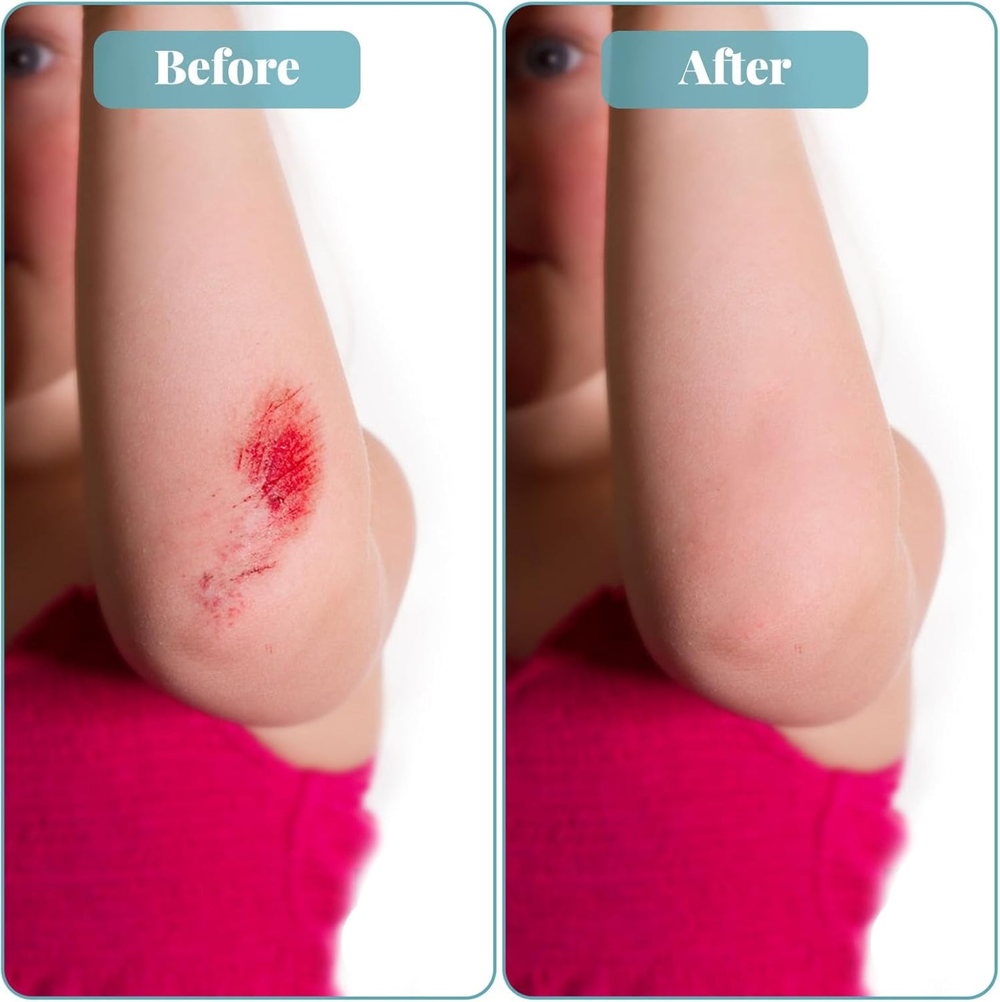 DERMTAPE Hydrocolloid Roll For Acne & Scarring