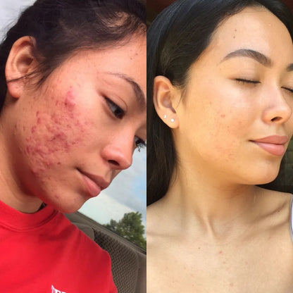 DERMTAPE Hydrocolloid Roll For Acne & Scarring