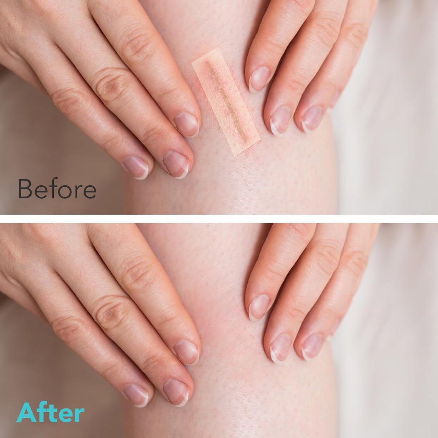 DERMTAPE Hydrocolloid Roll For Acne & Scarring